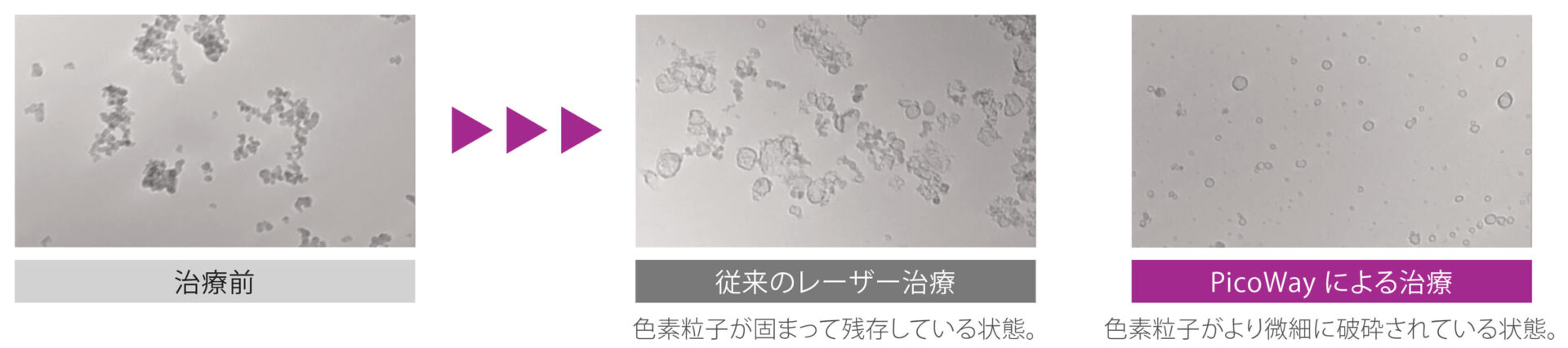 PicoWay®によるシミ治療の治療前後比較例（Before-After）