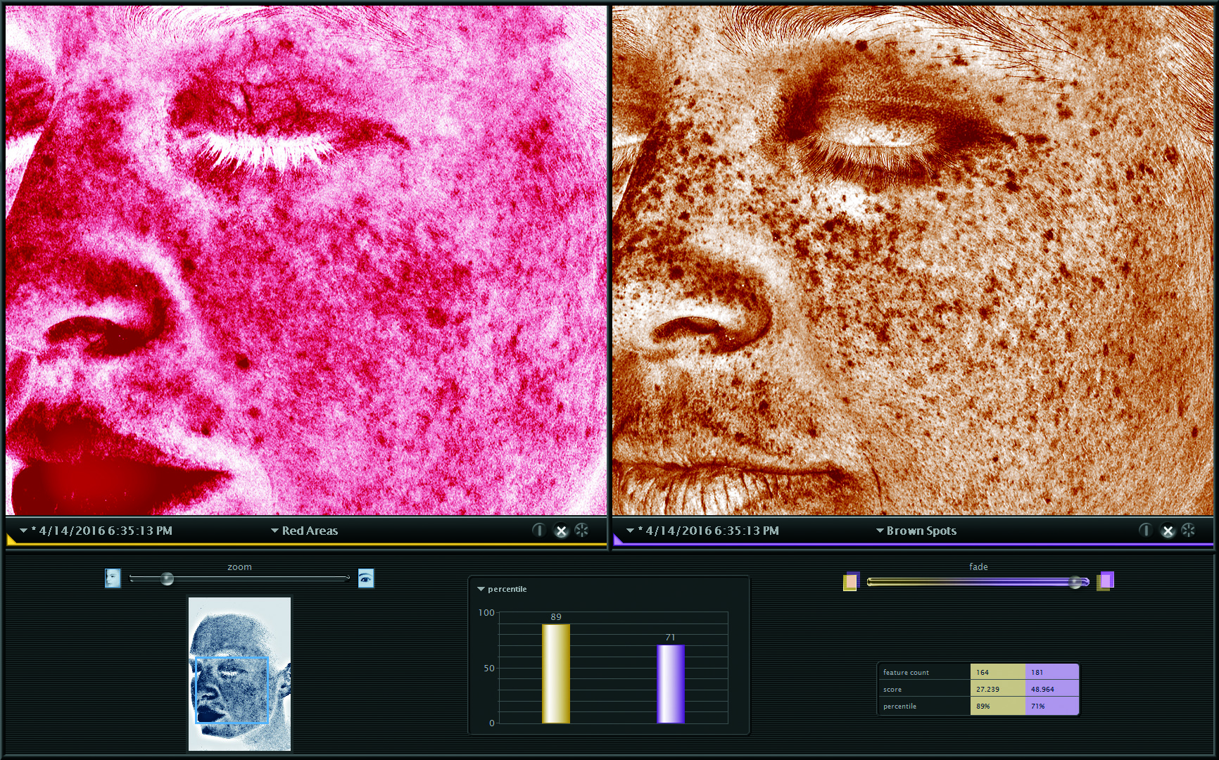 VISIA Evolution Red Areas（赤み）とBrown Spots（シミ）の解析画面比較