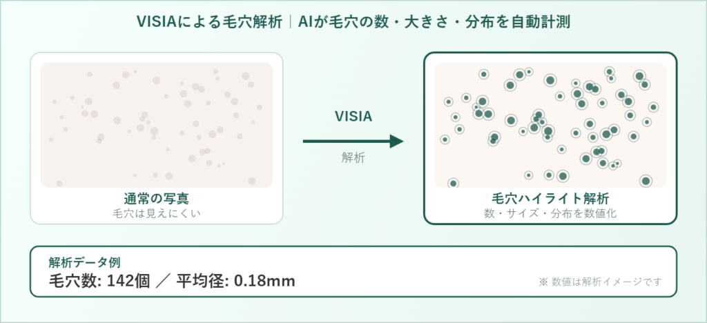 VISIAによる毛穴解析の概念図。通常の写真では見えにくい毛穴をAIが自動検出してハイライトし、数・大きさ・分布を数値化する流れ｜五良会クリニック白金高輪2F
