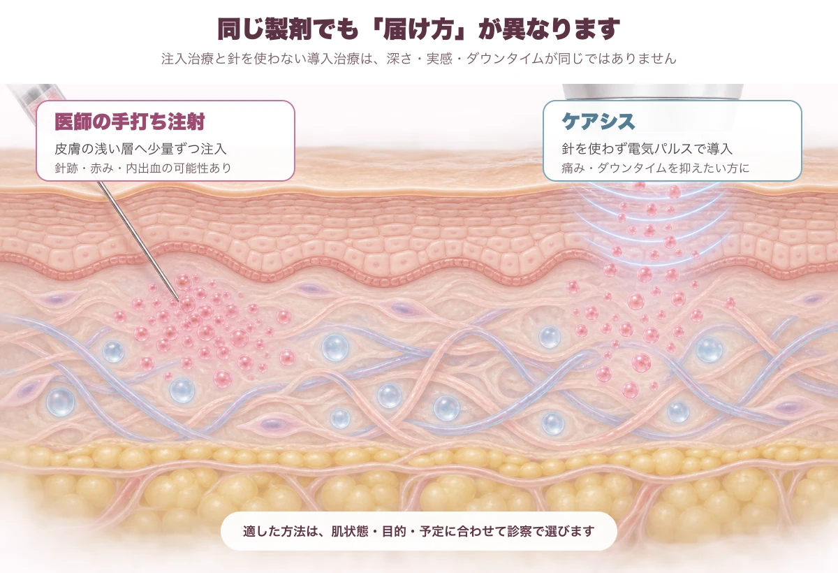 ピンクグローの手打ち注射とケアシスによる届け方の違い